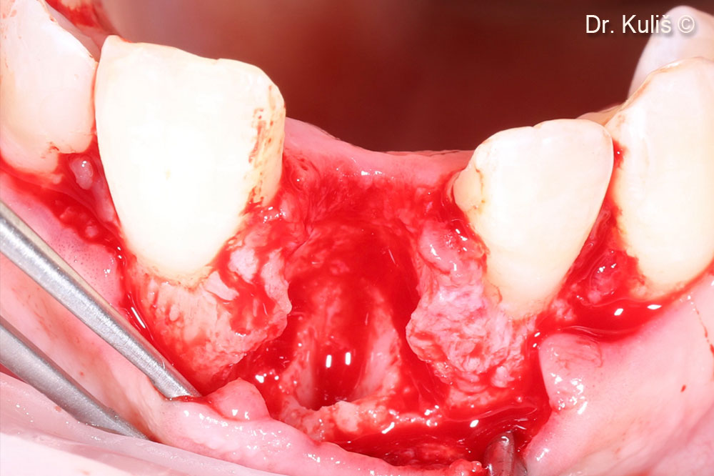 Buccal bone defect after extraction and removal of the granulation tissue