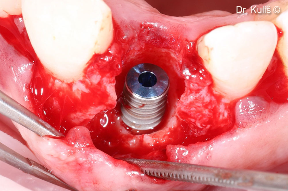 Implant placement (3.75mm diameter)