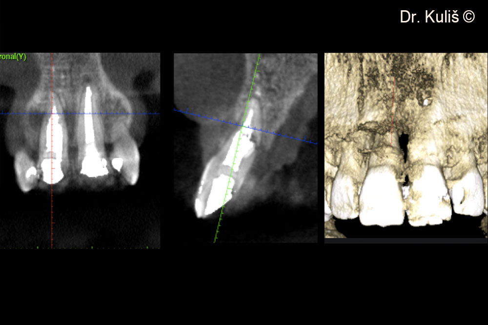 CBCT scan of the initial situation displays buccal bone defect with complete absence of the buccal bone