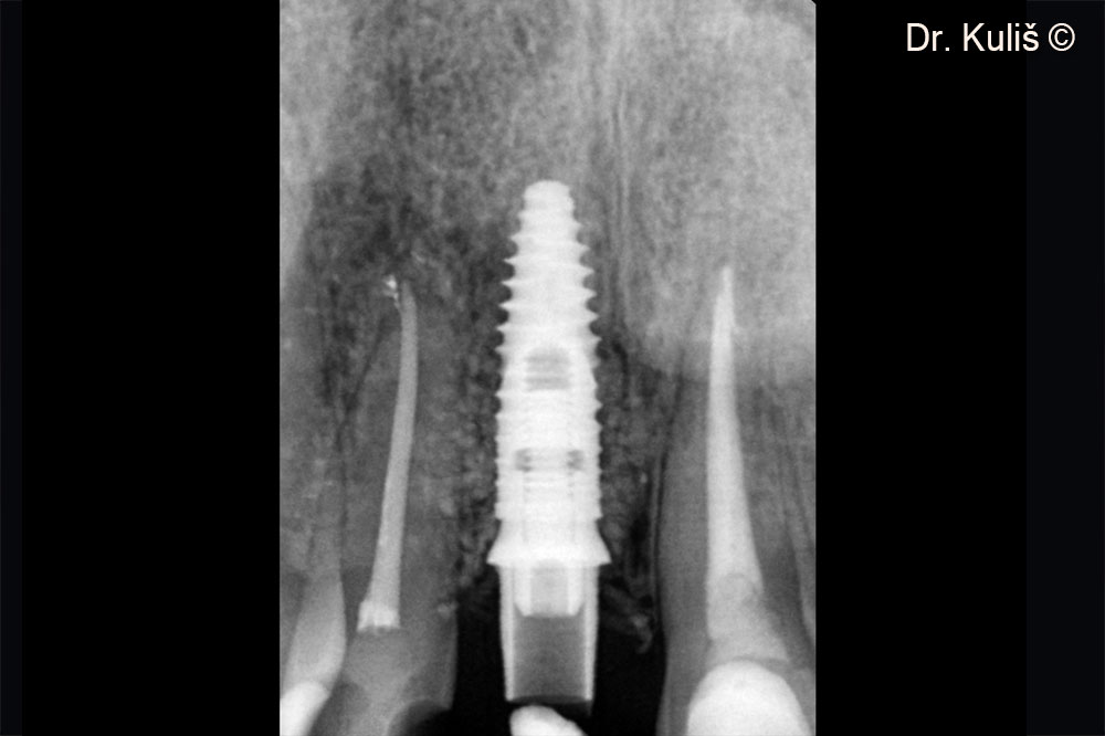 X-ray taken after second stage