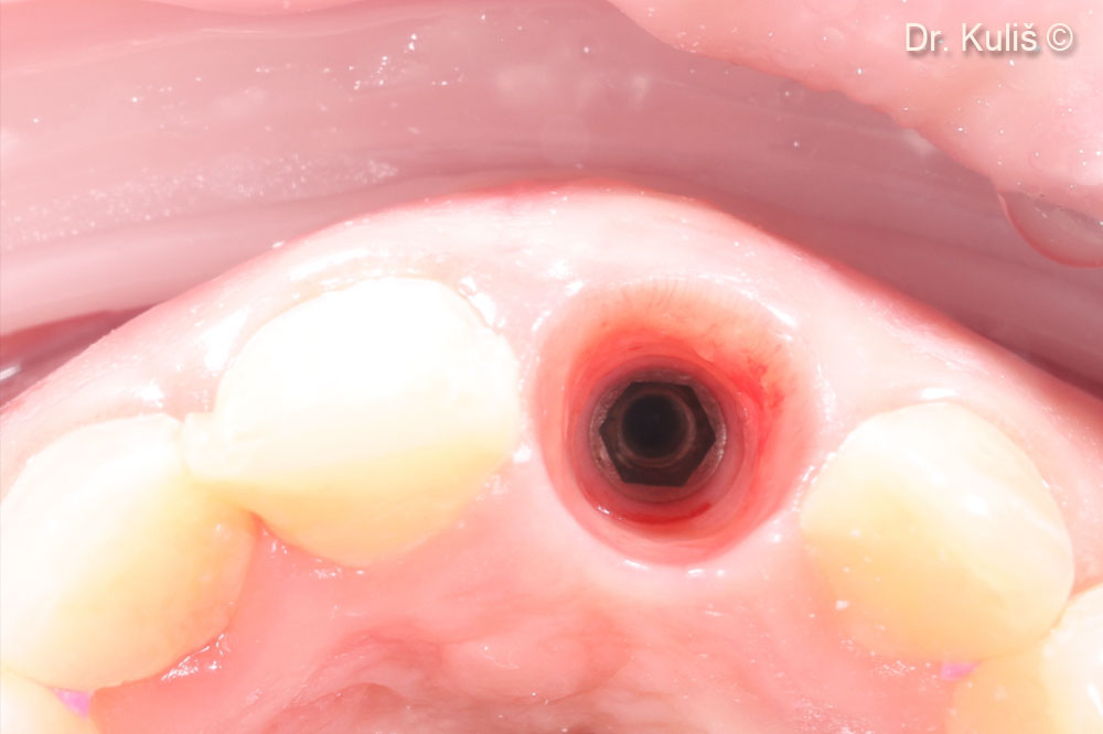 Emergence profile after two months of the healing