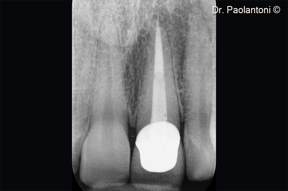 Upper Left incisor with horizontal fracture of the root