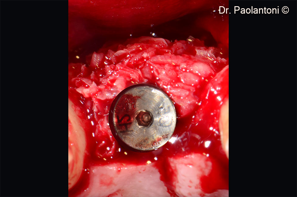 Gen-Os is used in the buccal portion to fill the bone defect