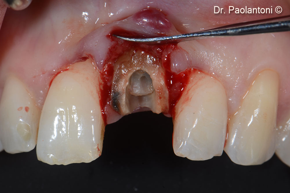 Upper Left incisor with horizontal fracture of the root