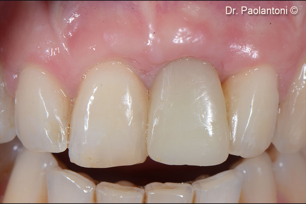 Temporary screwed composite rehabilitation