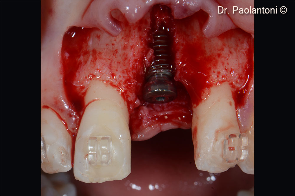 Implant positioning 