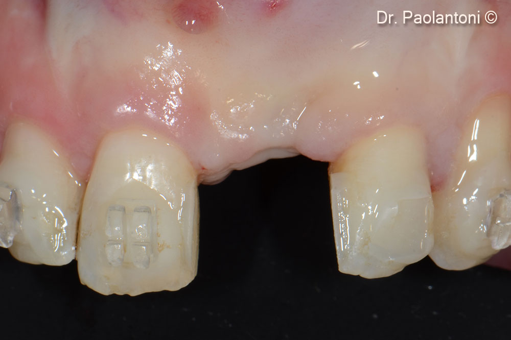 After 6 months this was the aspect of edentulous area