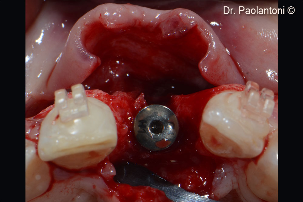 Implant positioning 