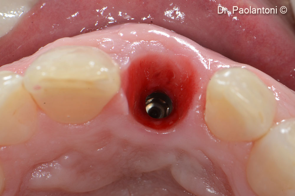 A close-up view of the peri-implant tissue