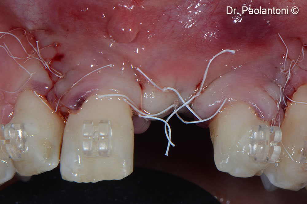The Flap Clousure with 6.0 goretex suture