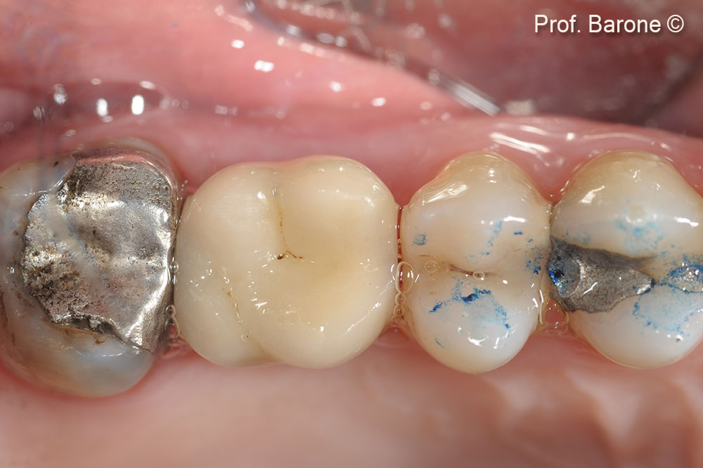 Final Restoration at 3-year follow-up 