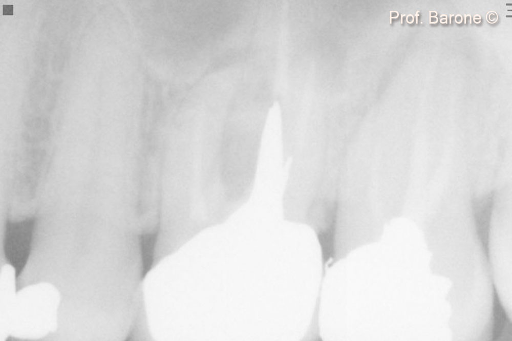 Periapical Radiograph 