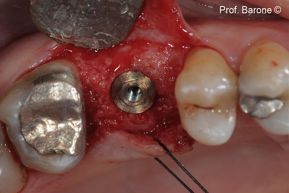 Implant Placement after 5 months 