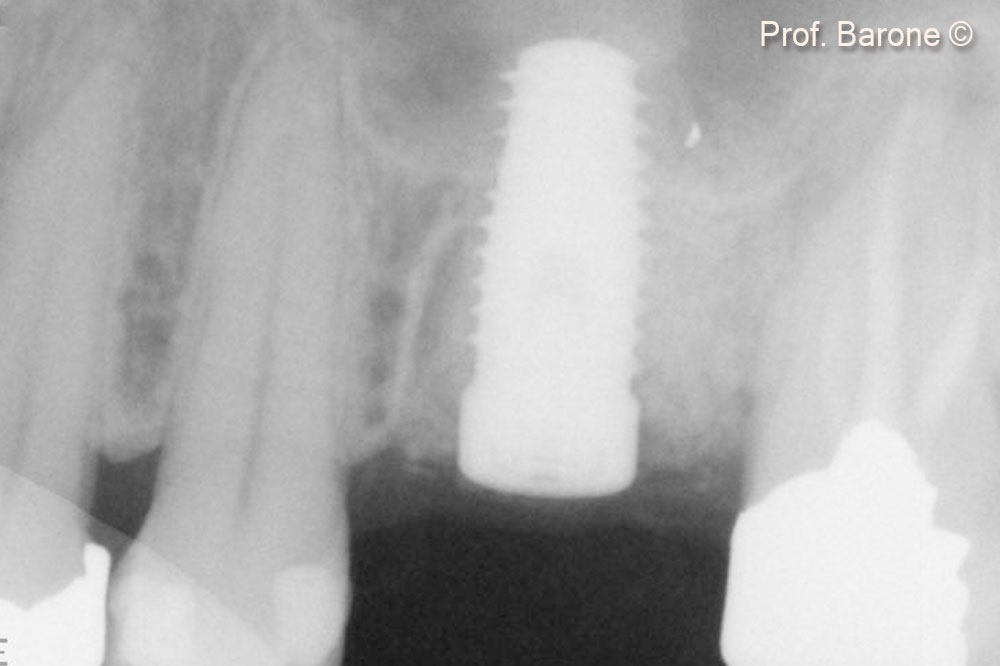 Periapical Radiograph immediately after implant placement 