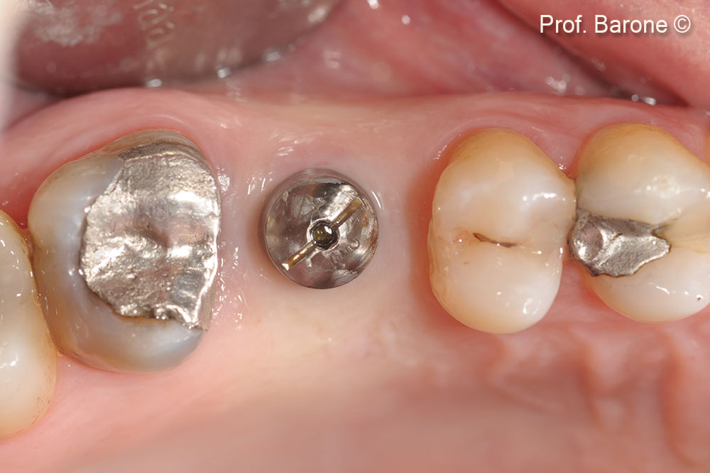 Healing Abutment, Occlusal View 