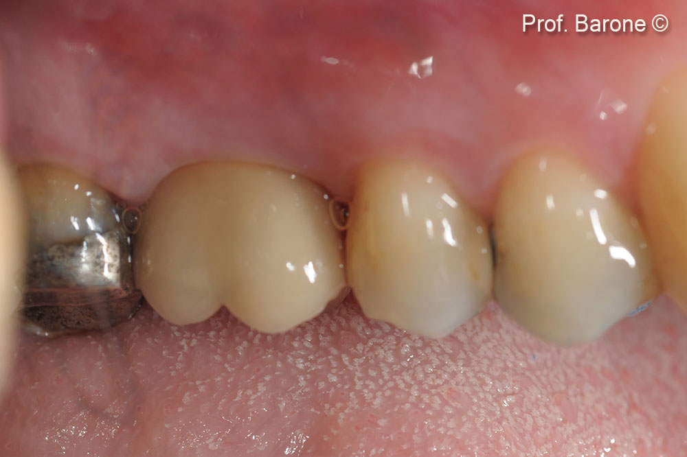 Final Restoration at 3-year follow-up 