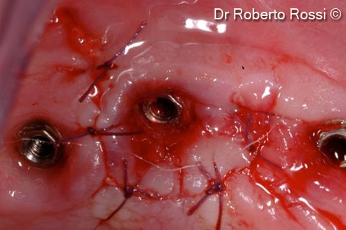 8. Flap closure after positioning a perforated membrane.