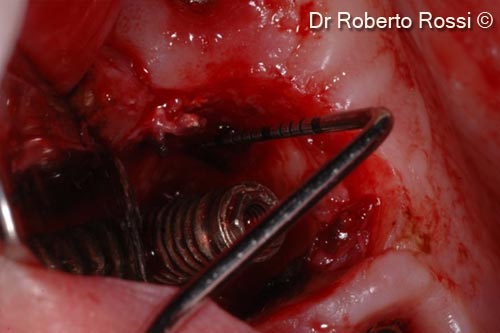 6. Peri-implant defect