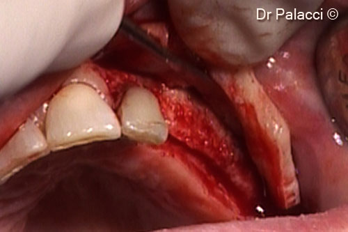 9. The implants are placed into a very dense bone (N. 22-24-26)