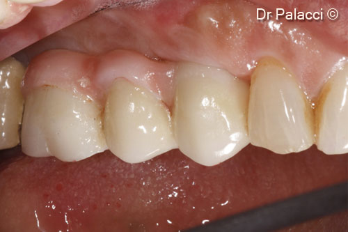 13. Prosthetic restorations in place. Upper left and right