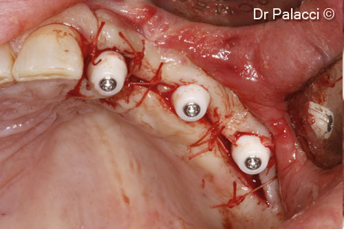 11. Four months later a flap is elevated and abutments placed into a very stable bone (ISQ ostell between 72 and 78)
