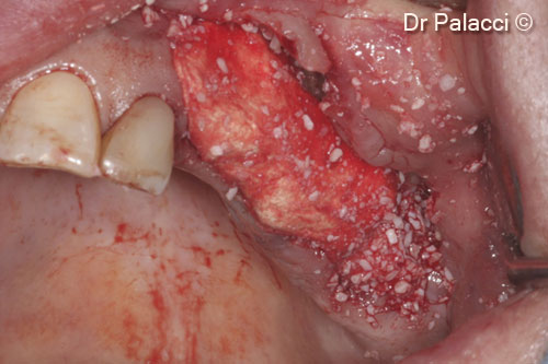 5. A collagen sponge is placed above the MP3 giving more stability to the material and adding volume to the soft tissues