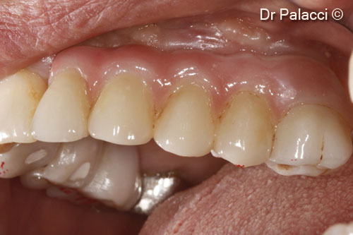 12. Prosthetic restorations in place. Upper left and right