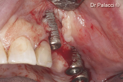2. Full thickness flap elevated showing implants placed partly outside the alveolar ridge