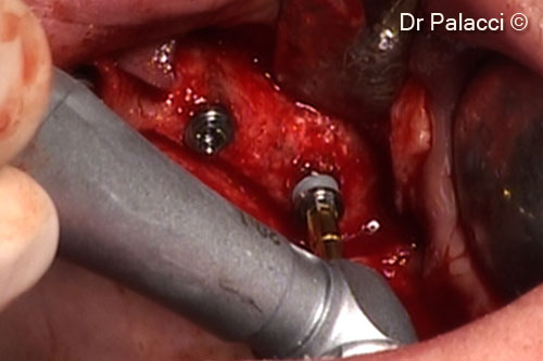 8. The implants are placed into a very dense bone (N. 22-24-26)