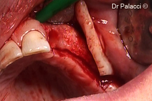 6. Four months later a flap is elevated