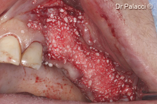 4. Ridge reconstructed with mp3 carefully compacted against the plate of bone