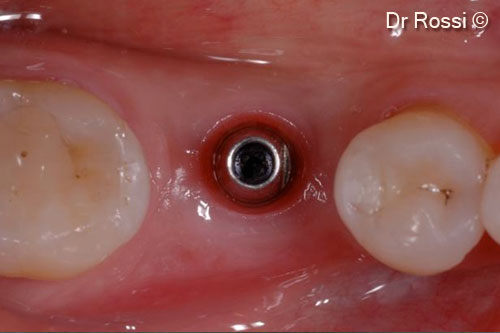 11. Stability of the peri-implant tissues