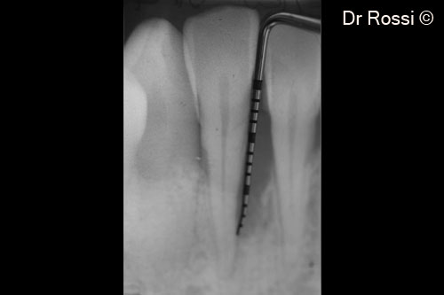 2. Loss of attachment, 15 mm