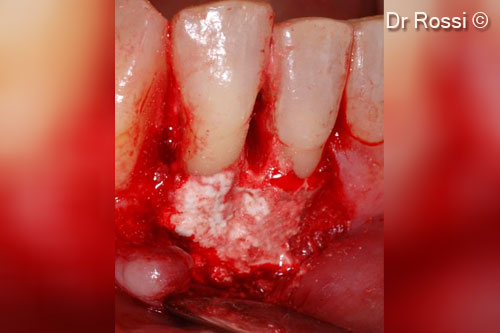 5. OsteoBiol® <i>Gen-Os®</i> graft covered with an OsteoBiol® <i>Evolution</i> membrane (fine)