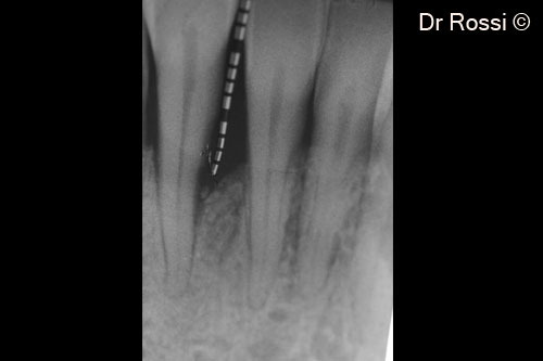 7. Attachment gain and regeneration of the intrabony defect (98%)
