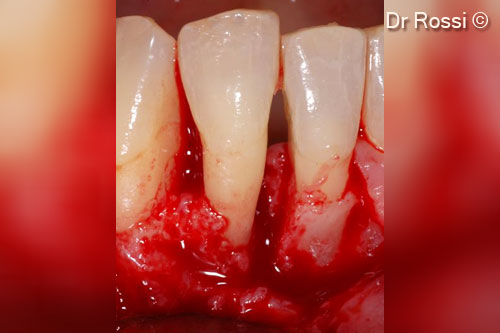 4. Intrabony 2-walls defect, 5 mm