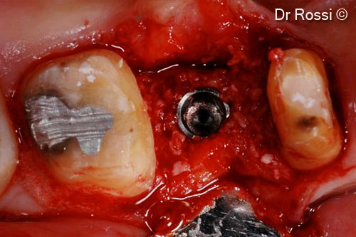5. OsteoBiol® <i>Gen-Os®</i> graft