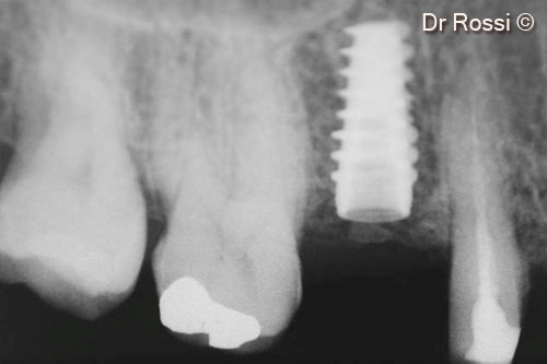 12. Final x-ray