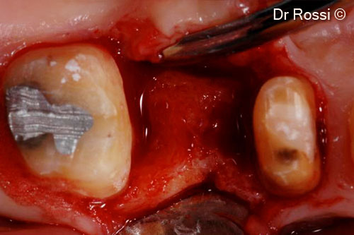 3. Bone defects