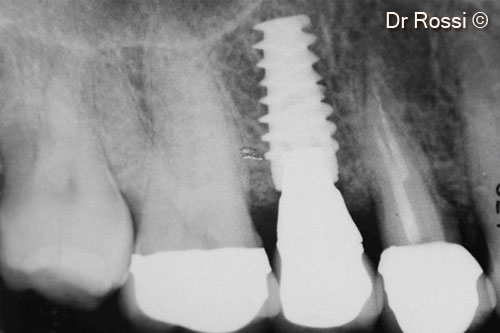 11. Supracrestal regeneration