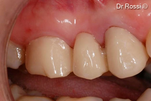 2. Defect area