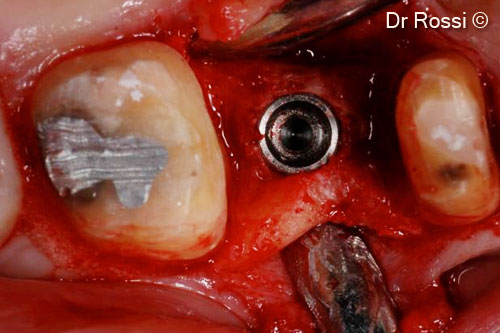 4. Implant positioning