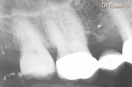 1. Pre-operative x-ray