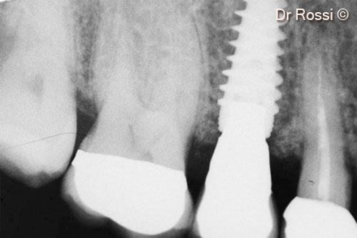 13. Final x-ray with regenerated bone above implant threads