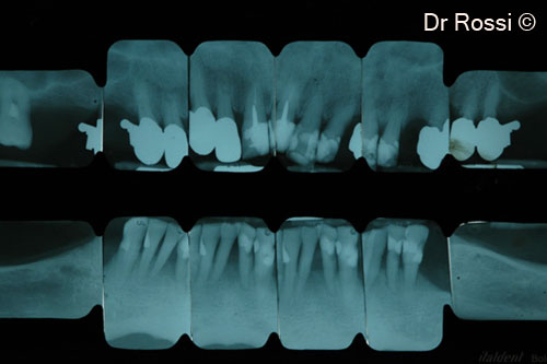2. Initial endoral x-rays showing severe bone deficits both at maxillary and mandibular levels