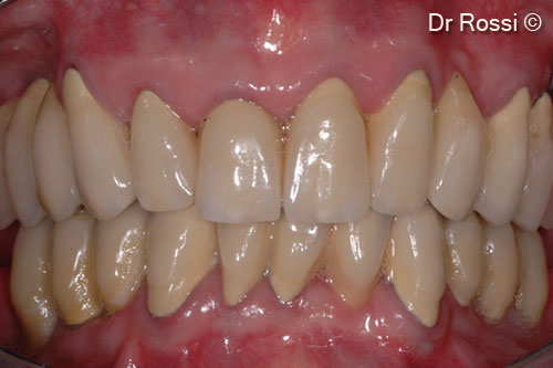 9. Intraoral image after 1 year from surgery (8 months after implant loading)