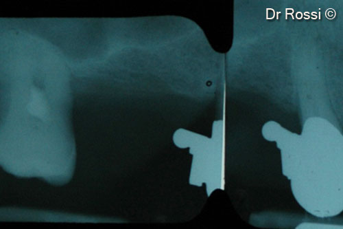 3. Detail of endoral x-ray (ERSE) showing the severe maxillary deficit