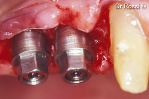 7. Implant placement