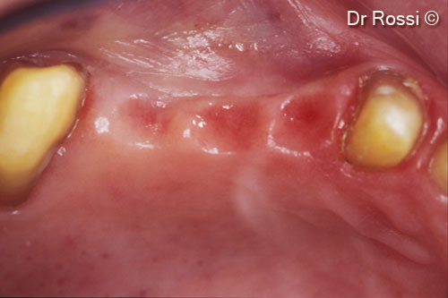 4. Pre-treatment clinical image after prosthesis removal