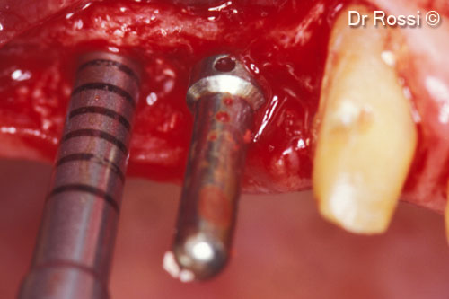 5. Maxillary sinus lift with crestal access: osteotomy before grafting with OsteoBiol® <i>Gel 40</i>